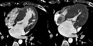 Recurrent Small Cell Carcinoma of the Lung  With Cutaneous Metastasis in Breast