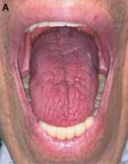 FIGURE 1. Dry Mouth Before Systemic Steroids Course (A) Clinical examination