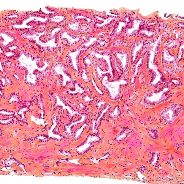 Micrograph of prostate adenocarcinoma, intermediate magnification