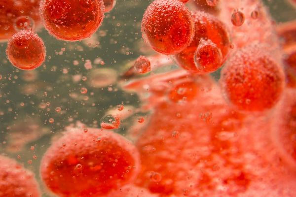 Data from the phase 2 ERASMM trial support further evaluation of elranatamab among patients with high-risk smoldering multiple myeloma.