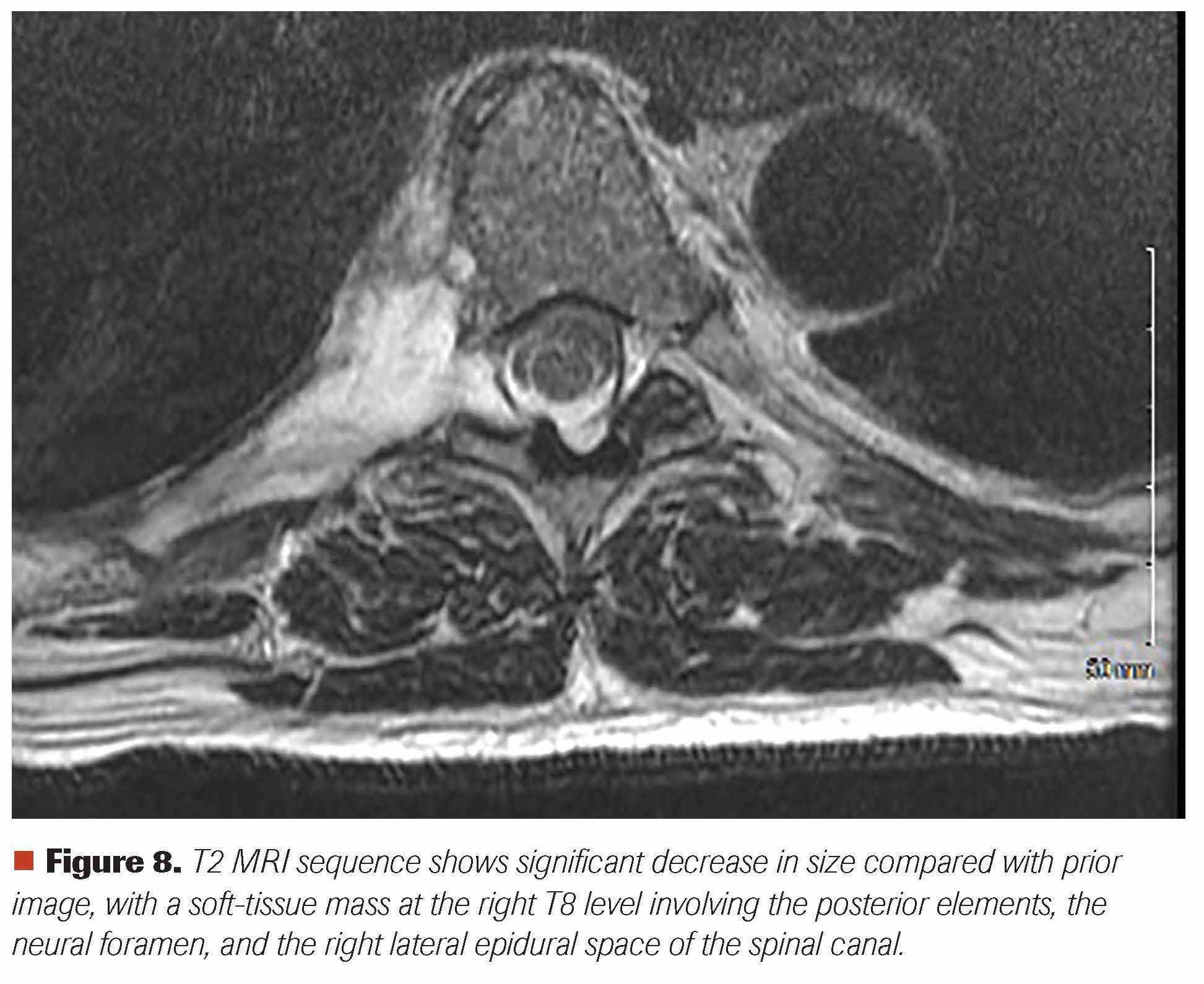 Figure 8. T2 MRI sequence shows significant decrease in size compared with prior image, with a soft-tissue mass at the right T8 level involving the posterior elements, the neural foramen, and the right lateral epidural space of the spinal canal.