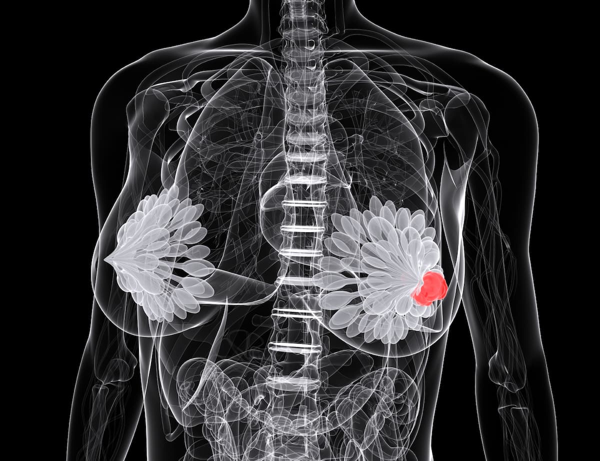 Greater Ki67 Suppression Achieved With Giredestrant Compared With Anastrozole in ER+/HER2– Early Breast Cancer