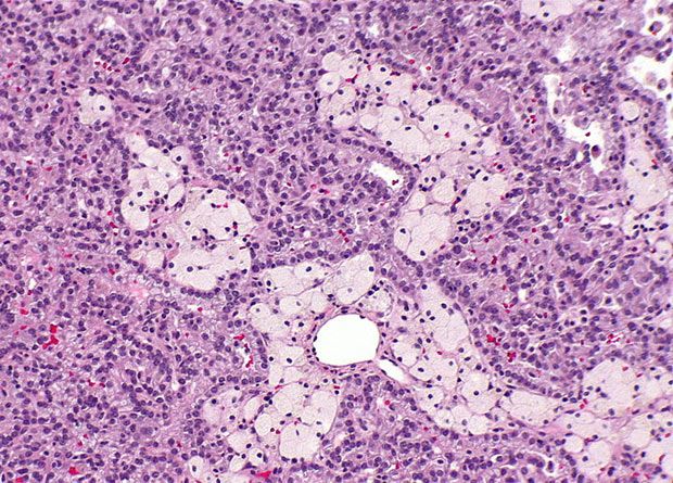 Mucinous Rcc Slide Show: Renal Cell Carcinoma