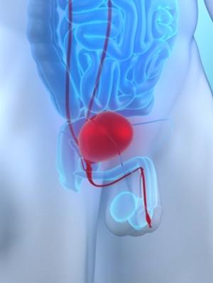 Data from POTOMAC support durvalumab plus BCG and induction and maintenance therapy as a new treatment option in BCG-naive, high-risk NMIBC.
