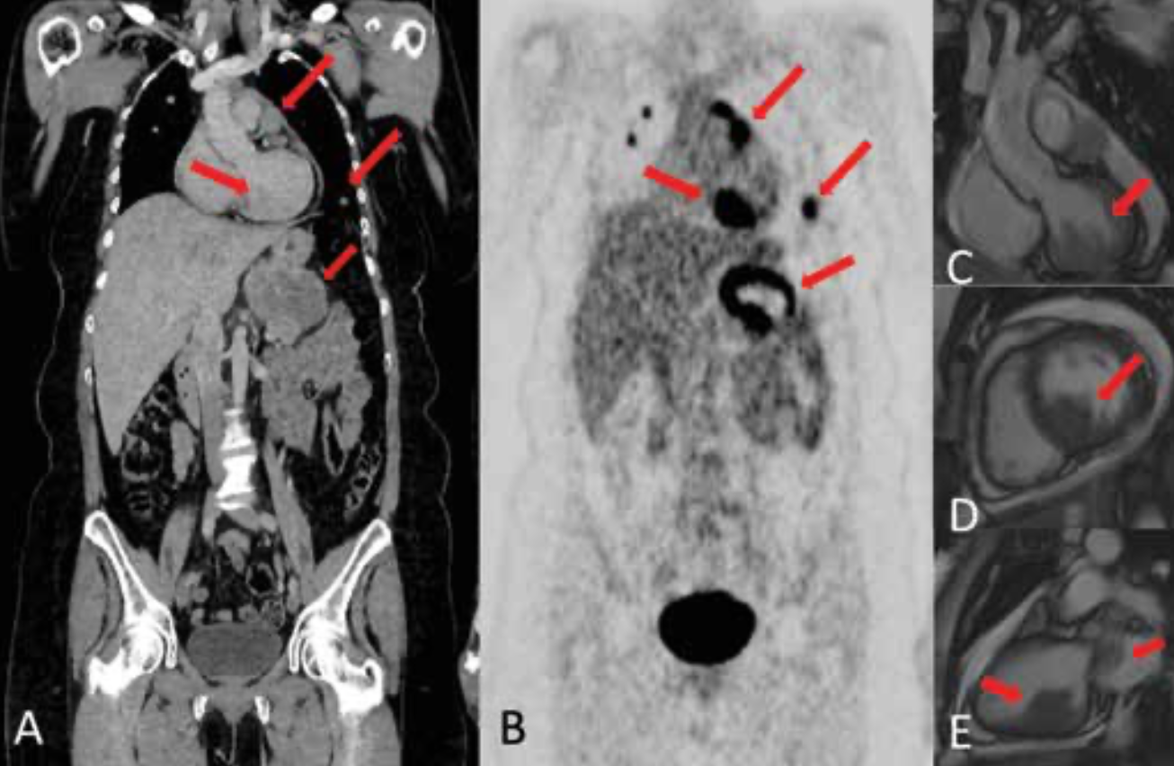 FIGURE 1. PET-CT scan (A, B) reveals metastatic disease in mediastinum, myocardium, lung,
and pancreas. Cardiac MRI shows a lesion
(C, D, E) in the left ventricle infiltrating the papillary muscles and the ventricular wall. Intravascular lesion in the pulmonary artery is present, with outflow obstruction.
