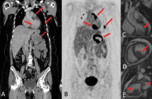 Oligoprogression After Immunotherapy and Targeted Therapy in Metastatic Melanoma