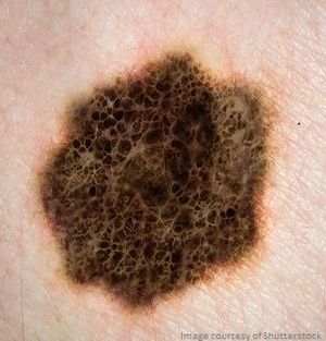 Molecular Predictors May Help Determine Outcome for Melanoma Patients