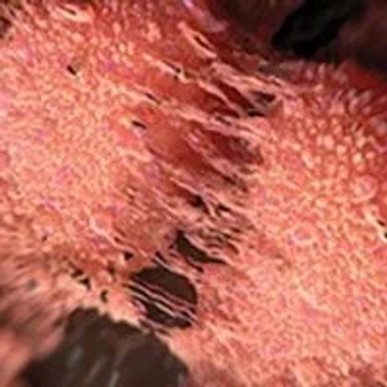 Findings support the use of 18F-PSMA-1007 PET/CT in the preoperative workflow of intermediate- and high-risk prostate cancer.