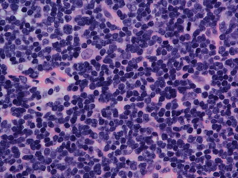 Allogeneic stem cell transplant should be strongly considered as a treatment for patients with mantle cell lymphoma who are adequately fit, according to Thomas E. Lew.