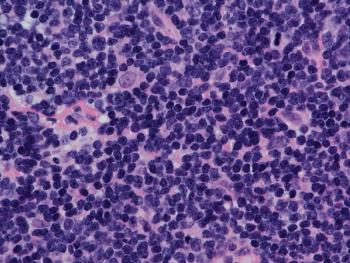 Overall survival rates at 12 and 36 months appear to favor the addition of acalabrutinib to bendamustine and rituximab in the treatment of those with mantle cell lymphoma in a phase 1b trial.