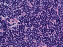 Addition of Lenalidomide to Rituximab Consolidation Misses PFS End Point in Mantle Cell Lymphoma