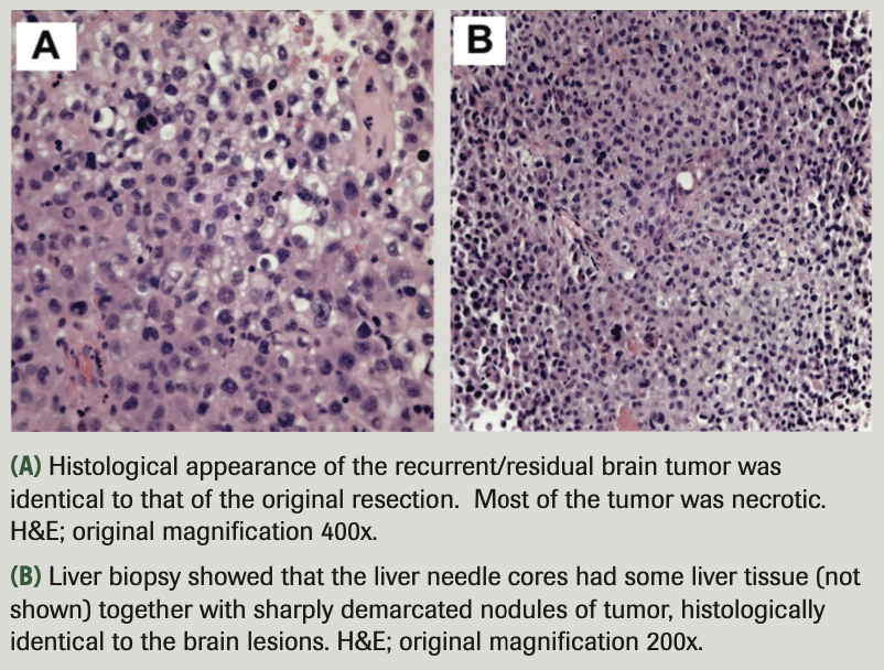 FIGURE 5. Tumor Pathology
