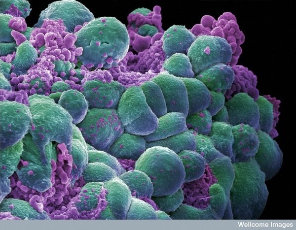 Sac-TMT demonstrated a significant improvement in PFS vs chemotherapy as first-line treatment for unresectable locally recurrent or metastatic TNBC.