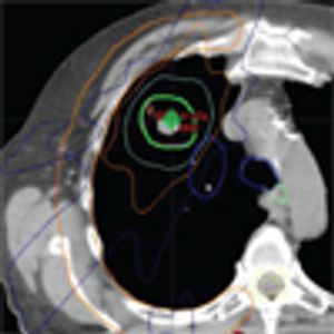 Stereotactic Body Radiation Therapy as an Alternative to Surgery in Early-Stage Non–Small-Cell Lung Cancer