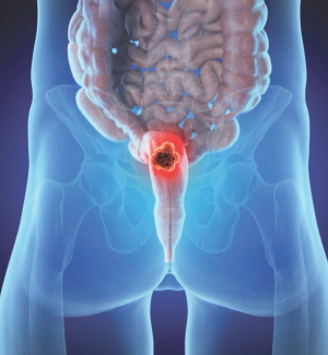 Chemo/Radiation Did Not Yield Increased Pelvic Malignancies in Rectal Cancer