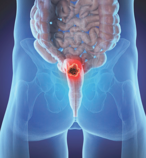 Radiotherapy Dose Escalation Did Not Improve Efficacy/QOL in Anal Cancer