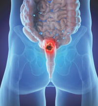Radiotherapy Dose Escalation Did Not Improve Efficacy/QOL in Anal Cancer