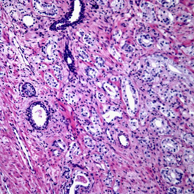 Prostate Biopsy From 67 Year Old Patient Cancer Network