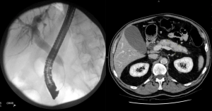 Painless Jaundice in a 62-Year-Old Patient