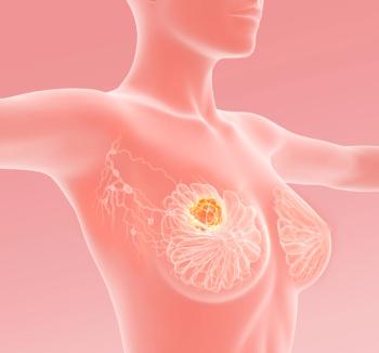 Breast cancer with lymphatics, medically 3D illustration: © Axel Kock - stock.adobe.com
