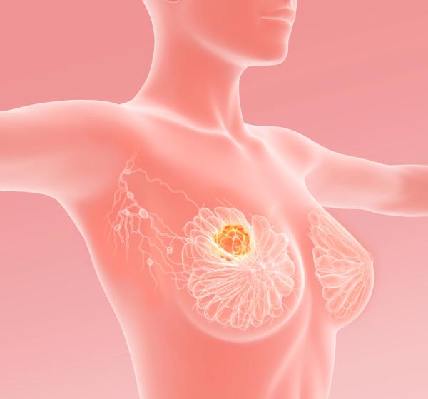 Breast cancer with lymphatics, medically 3D illustration: © Axel Kock - stock.adobe.com