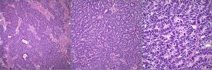 Mass Found in the Abdominal Area of a 3-Year-Old Child