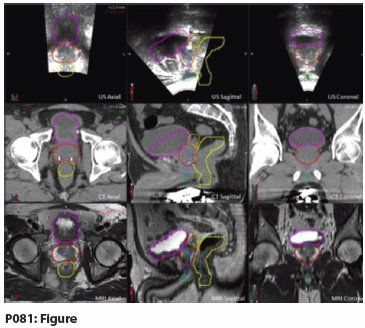 prostate anatomy ultrasound