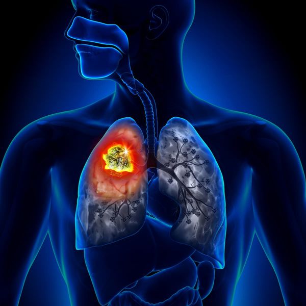 Sac-TMT Combo Improves PFS vs Pembrolizumab in NSCLC