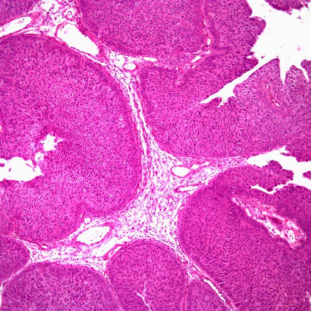 The regulatory agency has set a Prescription Drug User Fee Act date of April 23, 2024 for N-803 plus BCG as a treatment for BCG-unresponsive, non–muscle invasive bladder carcinoma.