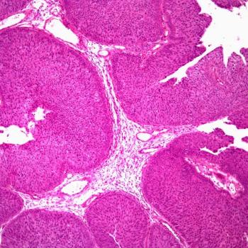 Findings from the phase 2 UNITE study indicate that certain biomarkers may help inform clinical decision making and sequencing in patients with advanced urothelial carcinoma.