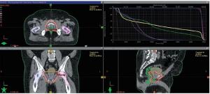 Post-Prostatectomy Radiation Therapy: Patient Selection, Timing, Imaging, and Therapy Intensification