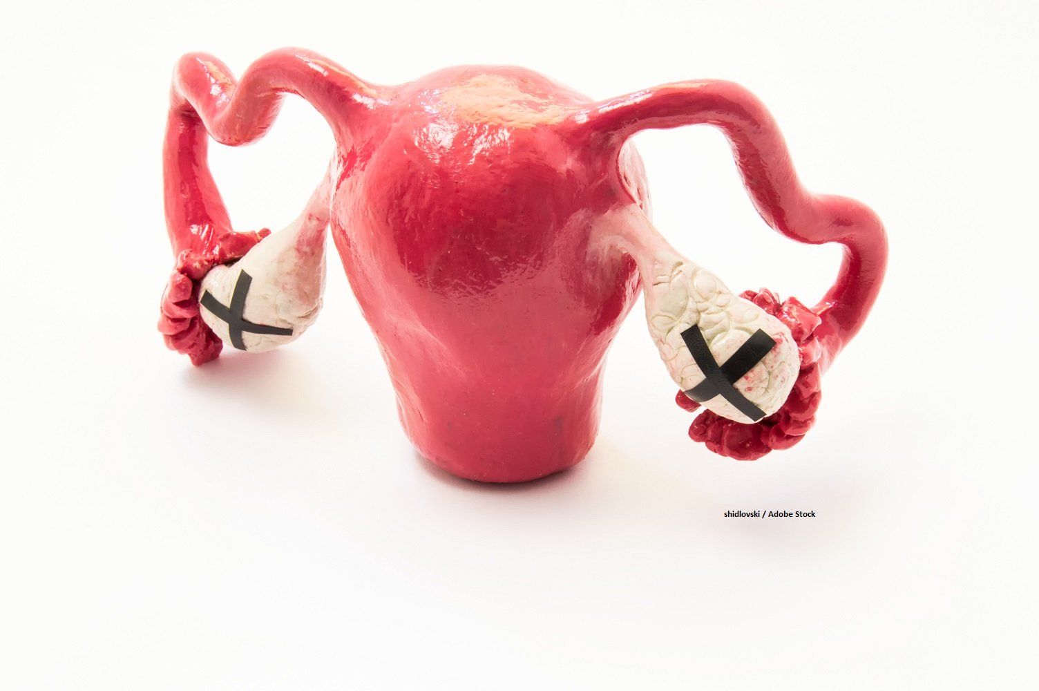 ovarian cyst, ovarian cancer