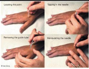 Understanding the Benefits of Acupuncture Treatment for Cancer Pain Management