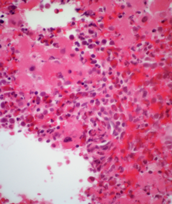 Chronic myeloid leukemia