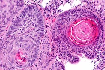 Neoadjuvant camrelizumab plus chemotherapy may hold promise as a standard of care in locally advanced esophageal squamous cell carcinoma, according to Yin Li, MD.