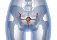 Phase 3 data demonstrate PD-L1 positivity and BRCA mutation status as prognostic for improved overall survival regardless of treatment arm.