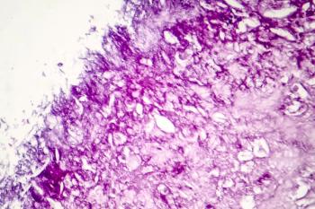 melanoma