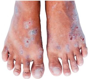 Regorafenib for Metastatic Colorectal Cancer: Common Toxicities and Prevention Strategies