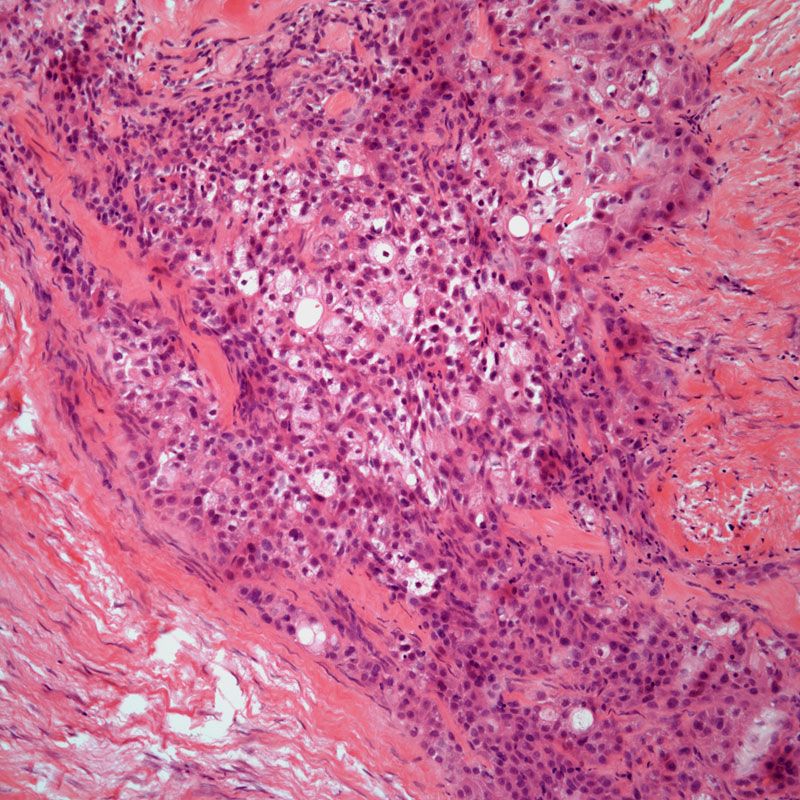 Parotid Gland Tumor in 42-Year-Old Patient | Cancer Network