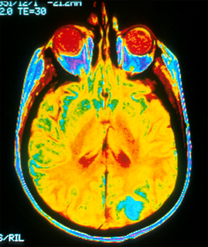 New Insights and Emerging Therapies for Breast Cancer Brain Metastases
