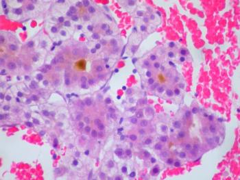 Hepatocellular Carcinoma