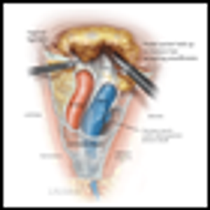 Minimizing Morbidity in Melanoma Surgery