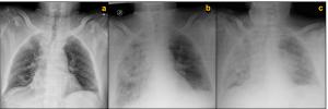 Challenges of Treating a Patient With Advanced Prostate Cancer During the COVID-19 Pandemic