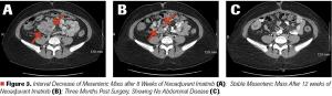 Locally Advanced Gastrointestinal Stromal Tumor in a 33-Year-Old Woman Seeking to Conceive