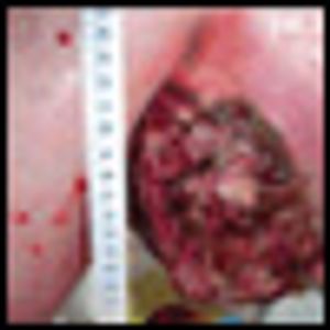 Metastatic Malignant Melanoma From an Unknown Primary Presenting as a Large Axillary Mass