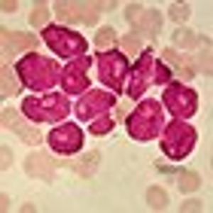 Courtney DiNardo, MD, on Need for Improved, Effective Regimens in IDH1-Positive AML