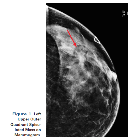 A 55 Year Old Woman With New Triple Negative Breast Mass Less Than 2 Cm On Both Mammogram And Ultrasound