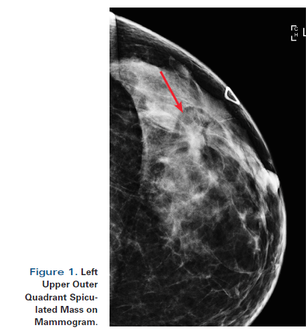 A 55 Year Old Woman With New Triple Negative Breast Mass Less Than 2 Cm On Both Mammogram And Ultrasound A 55 Year Old Woman With New Triple Negative Breast Mass Less Than 2 Cm On Both Mammogram And Ultrasound