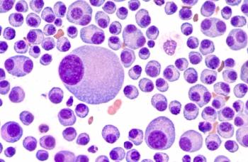 VITAL Post-Hoc Analysis Shows Longer Survival With Birtamimab in Stage IV AL Amyloidosis