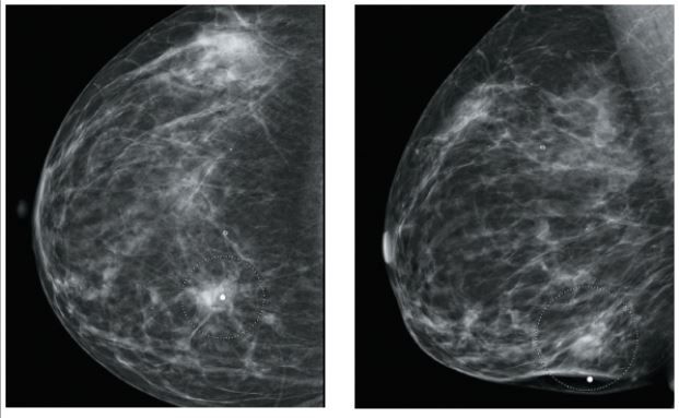 A 35-Year-Old Woman With a Change in HER2 Expression Following ...